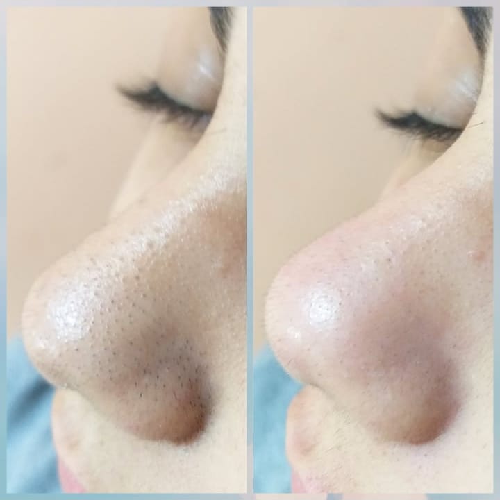 Tratamento para Acne